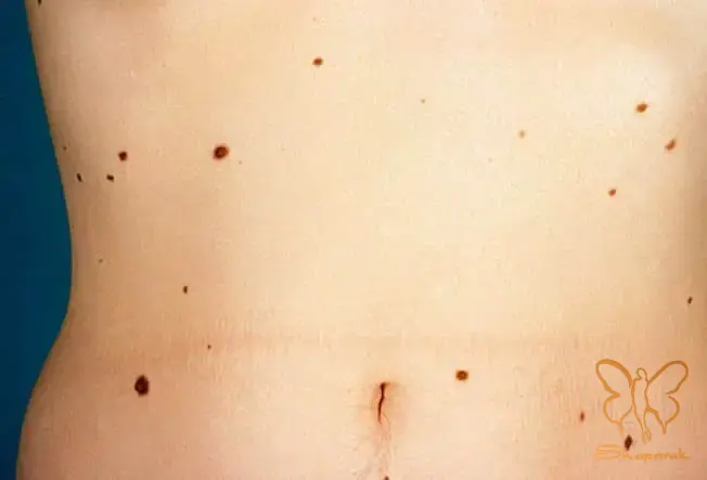 غربالگری خالهای غیرمعمول در کلینیک شاپرک طلایی