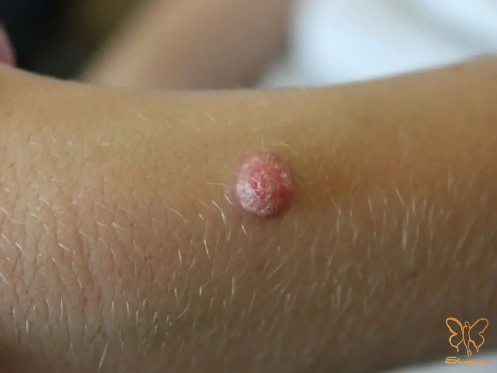 مدیریت و درمان خال اسپیتز در کلینیک شاپرک