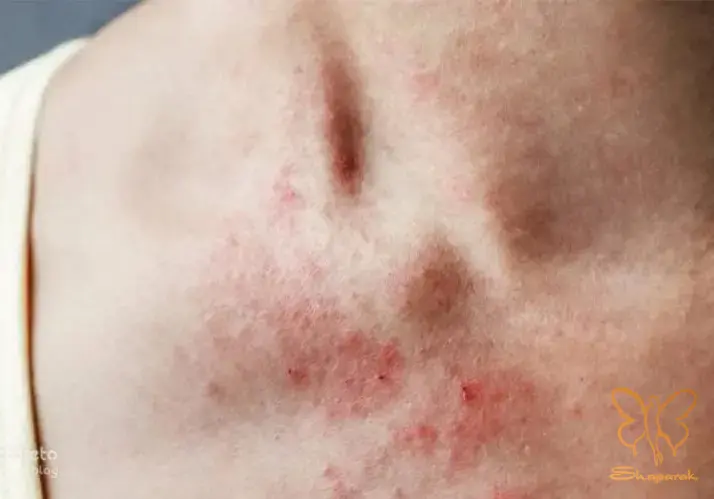 علائم اصلی و نواحی درگیر در اگزمای عصبی