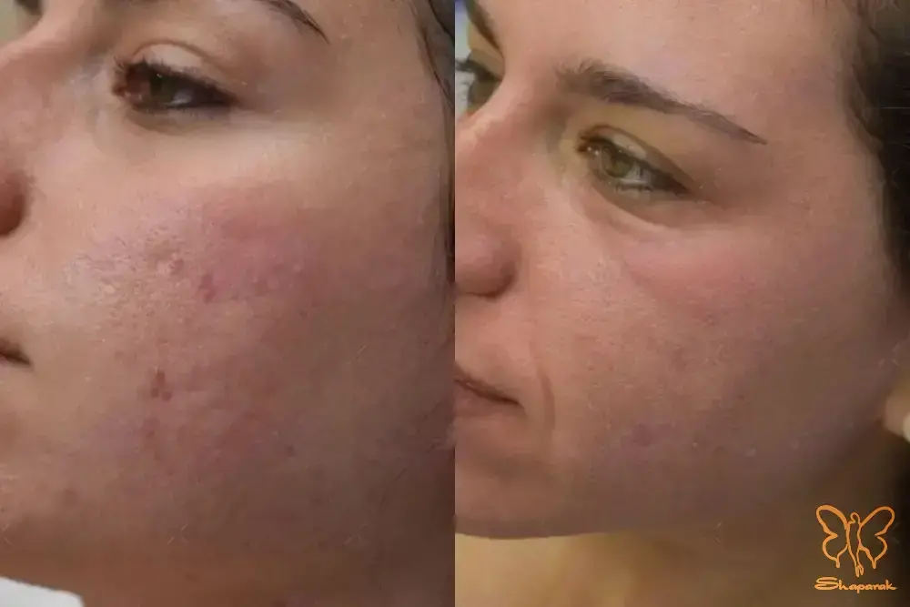 پیلینگ&nbsp;شیمیایی کنترل شده صورت مشهد