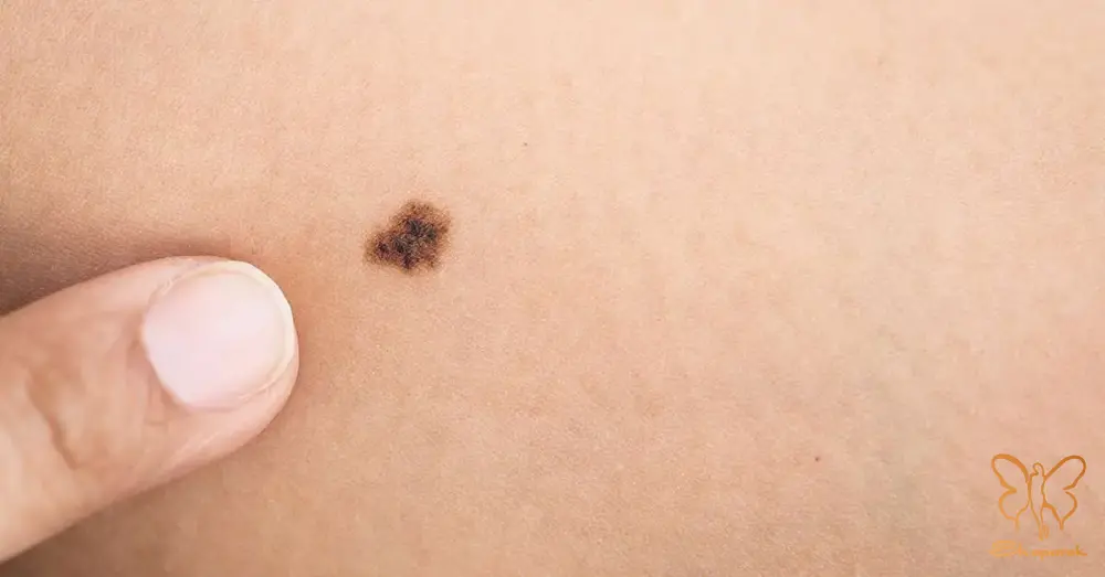 نقش ژنتیک و آفتاب در خالهای اکتسابی