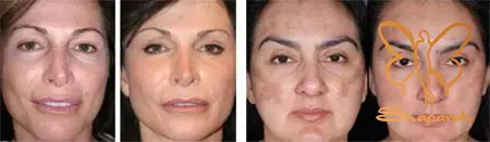  جوانسازی پوست