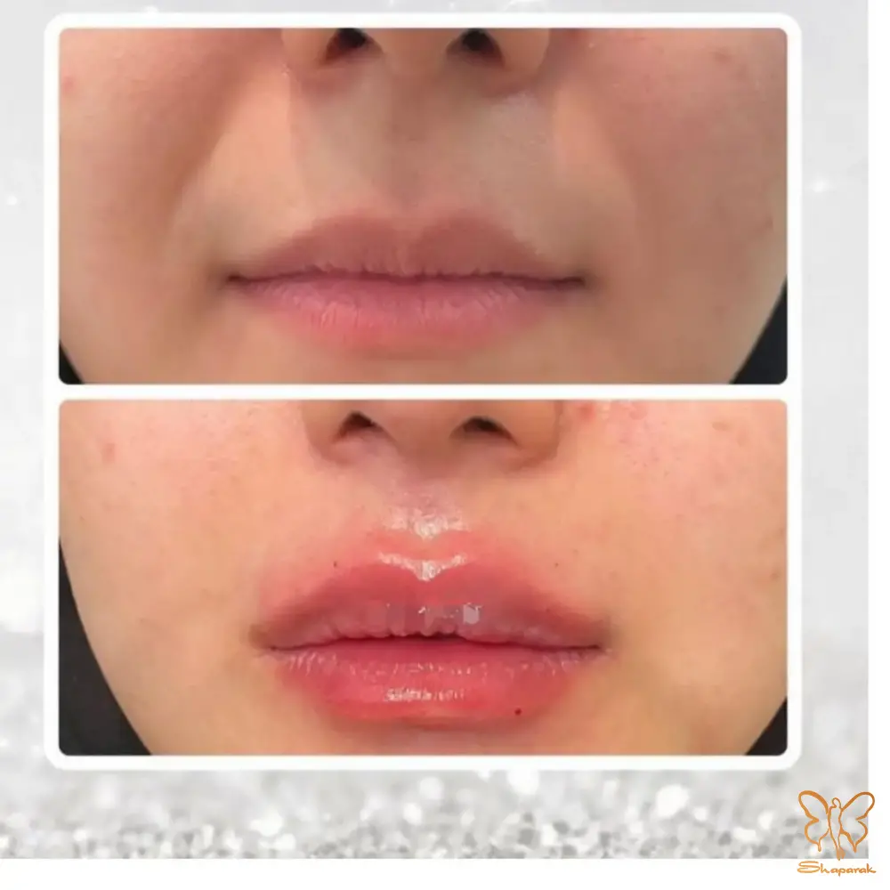 رسیدن به نتیجهای ایدهآل و طبیعی از تزریق فیلر یک فرآیند دوطرفه است که به تخصص بالای کادر درمانی و همکاری آگاهانه مراجع بستگی دارد انتخاب یک کلینیک معتبر مانند کلینیک تخصصی پوست و مو شاپرک طلایی در مشهد که از بهترین برندهای فیلر و پیشرفتهترین دستگاهها استفاده میکند اولین و مهمترین قدم است در مرحله بعد داشتن انتظارات واقعبینانه درک صحیح از قابلیتها و محدودیتهای فیلر و رعایت دقیق توصیههای مراقبتی پس از تزریق موفقیت درمان شما را تضمین میکند به یاد داشته باشید که فیلرها ابزاری برای بهبود و افزایش زیبایی طبیعی شما هستند نه تغییر کامل هویت چهره کادر پزشکی ما اینجا هستند تا با دانش و تجربه خود شما را در این مسیر به بهترین شکل راهنمایی کنند رسیدن به نتیجهای ایدهآل و طبیعی از تزریق فیلر یک فرآیند دوطرفه است که به تخصص بالای کادر درمانی و همکاری آگاهانه مراجع بستگی دارد انتخاب یک کلینیک معتبر مانند کلینیک تخصصی پوست و مو شاپرک طلایی در مشهد که از بهترین برندهای فیلر و پیشرفتهترین دستگاهها استفاده میکند اولین و مهمترین قدم است در مرحله بعد داشتن انتظارات واقعبینانه درک صحیح از قابلیتها و محدودیتهای فیلر و رعایت دقیق توصیههای مراقبتی پس از تزریق موفقیت درمان شما را تضمین میکند به یاد داشته باشید که فیلرها ابزاری برای بهبود و افزایش زیبایی طبیعی شما هستند نه تغییر کامل هویت چهره کادر پزشکی ما اینجا هستند تا با دانش و تجربه خود شما را در این مسیر به بهترین شکل راهنمایی کنند