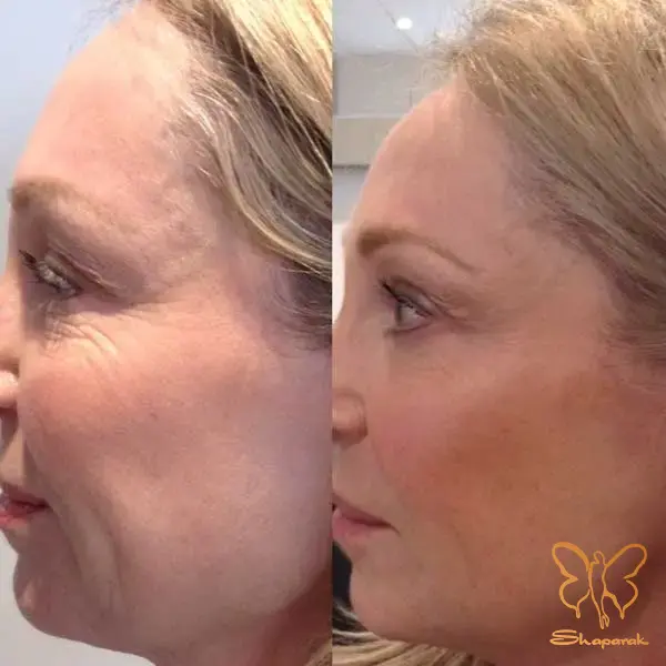 راز جوانی ماندگار با پروفایلو در مشهد راز جوانی ماندگار با پروفایلو در مشهد