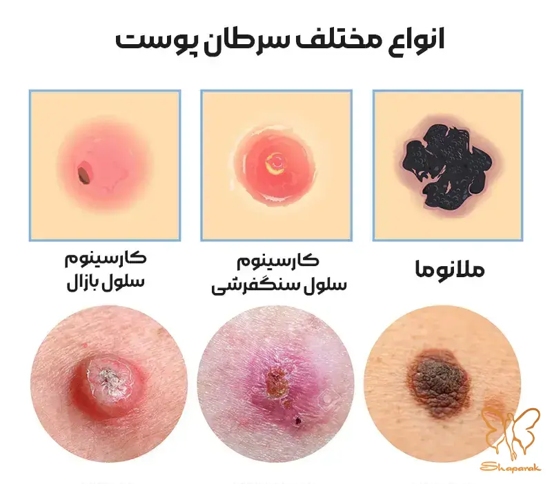 ملانوما Melanoma ملانوما Melanoma