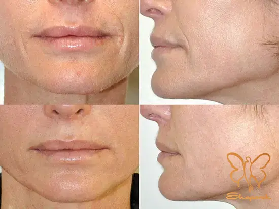 کاهش&nbsp;چین و چروک ها