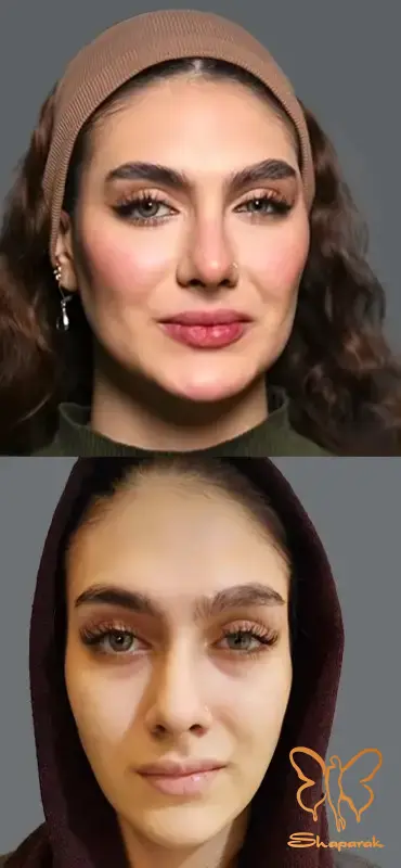 راز موفقیت مادلینگ صورت در کلینیک شاپرک مشهد راز موفقیت مادلینگ صورت در کلینیک شاپرک مشهد