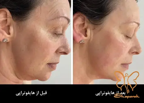 هایفو دابلو گلد پریمیوم مشهد هایفو دابلو گلد پریمیوم مشهد