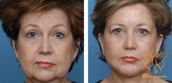 لیفت نخ سیلوئت آمریکایی Silhouette Soft صورت مشهد لیفت نخ سیلوئت آمریکایی Silhouette Soft صورت مشهد