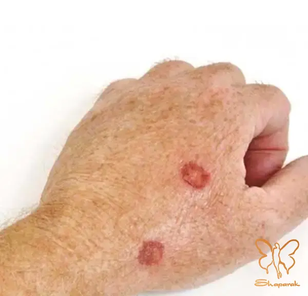 اشعه ماوراء بنفش UV خورشید اشعه ماوراء بنفش UV خورشید