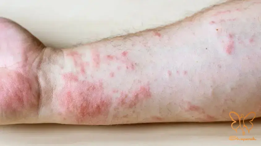 شناخت علائم هشداردهنده راش پوستی در کلینیک شاپرک مشهد