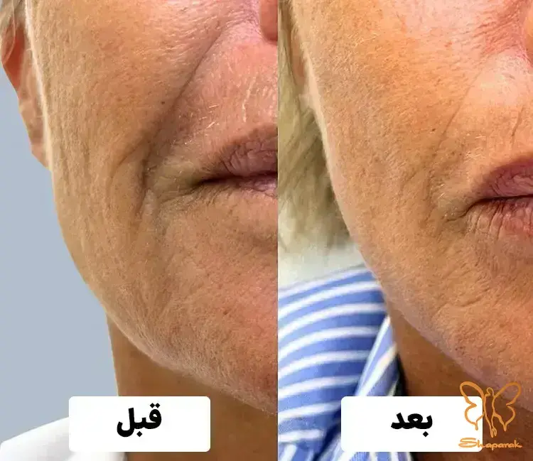  دستگاه CO2 فرکشنال صورت مشهد