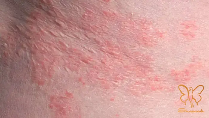 راش پوستی در ناحیه تناسلی
