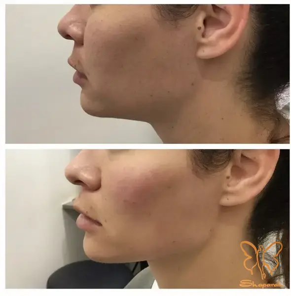 جوانسازی پوست جوانسازی پوست