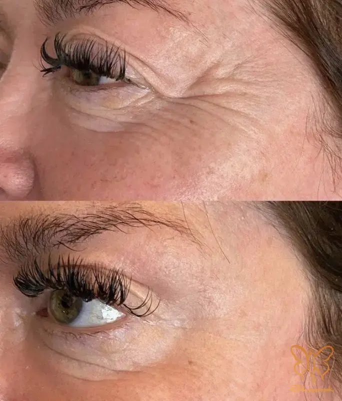 مزوتراپی پوست و مو در مشهد مزوتراپی پوست و مو در مشهد