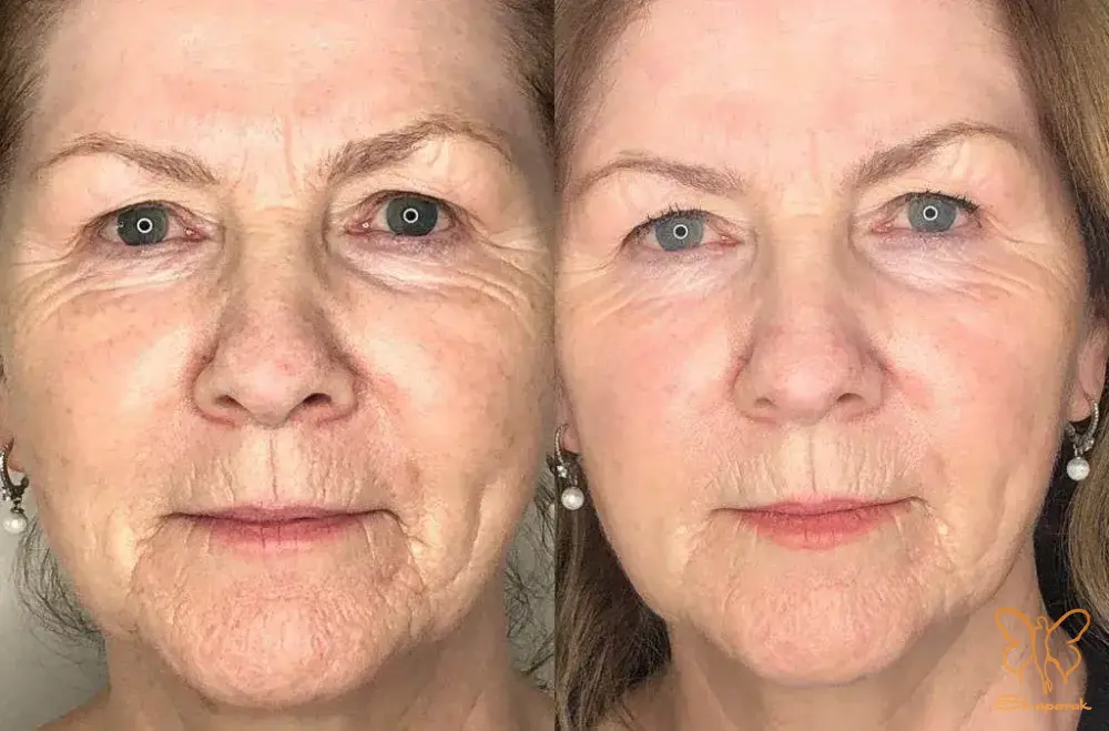 پروفایلو استراکچرا در مشهد پروفایلو استراکچرا در مشهد