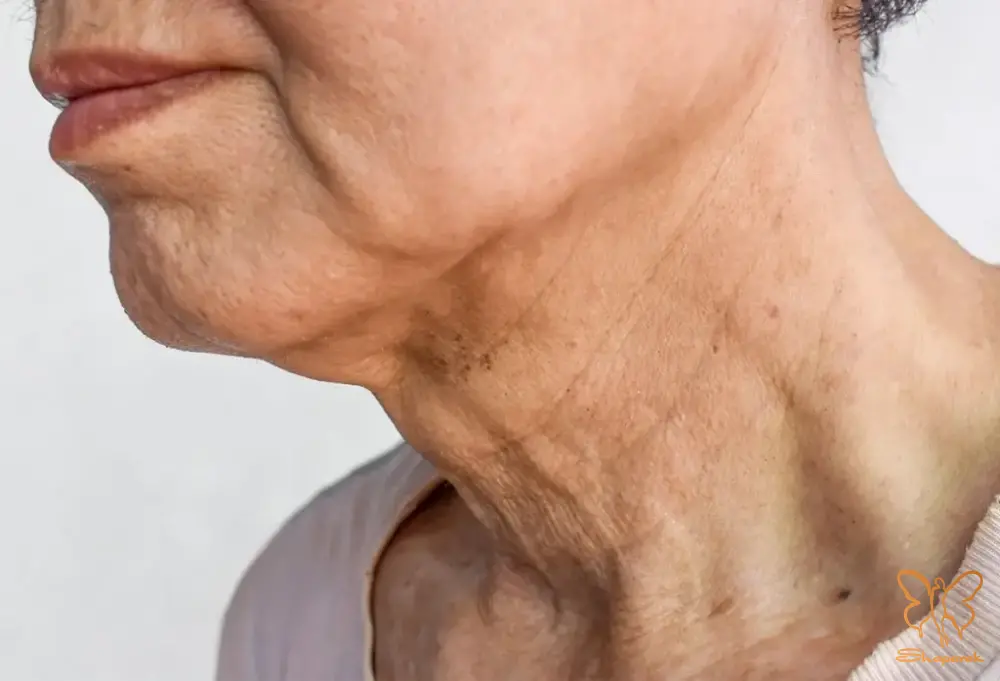 چین و چروک گردن