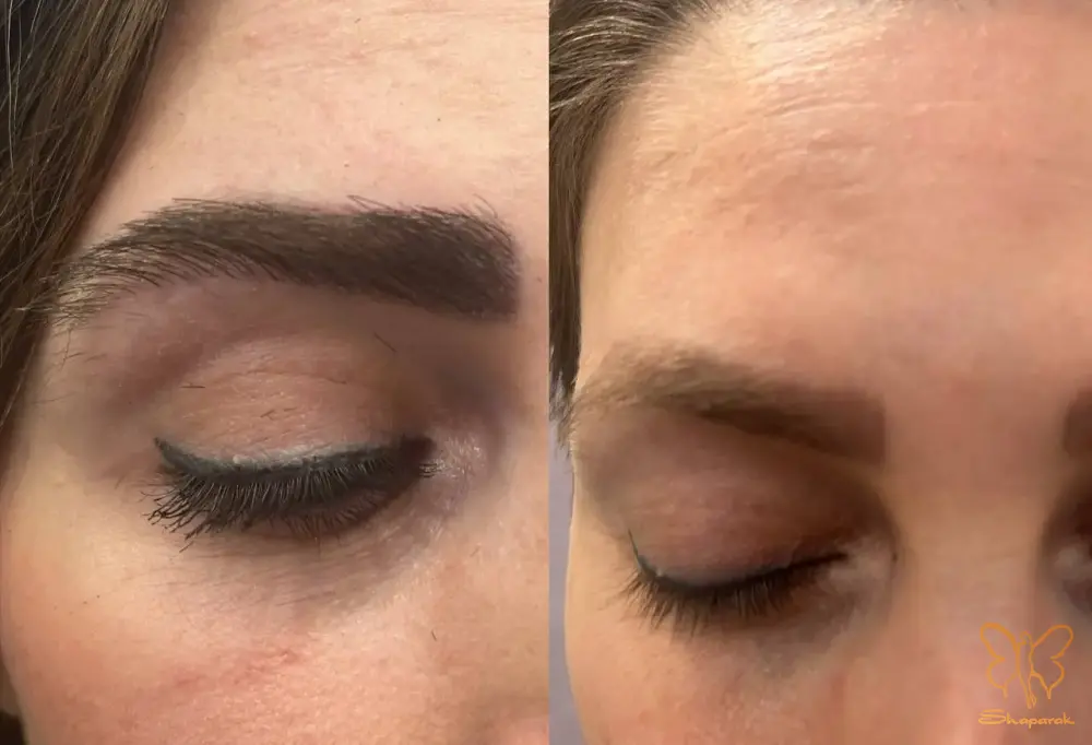 کاشت ابرو طبیعی چیست و این فرآیند چگونه انجام میشود