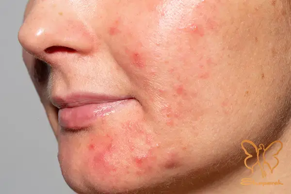 ویژگیهای ظاهری و حسی آکنه ندولار ویژگیهای ظاهری و حسی آکنه ندولار