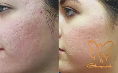 کلینیک شاپرک مشهد درمان های هوشمندانه و ماندگار پوست کلینیک شاپرک مشهد درمان های هوشمندانه و ماندگار پوست