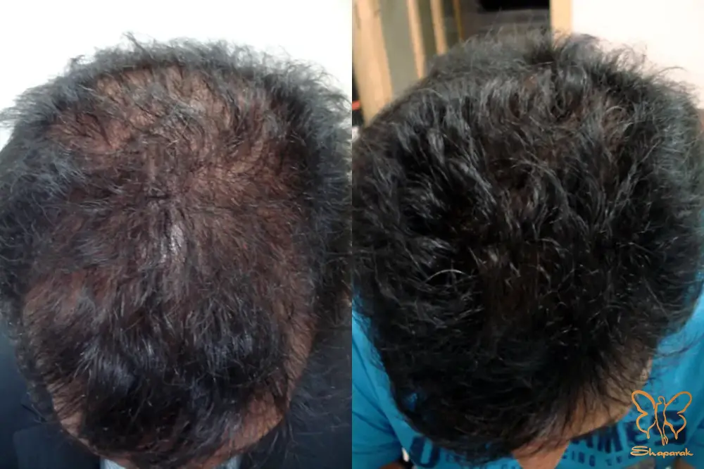 مزوتراپی پوست و مو در مشهد مزوتراپی پوست و مو در مشهد