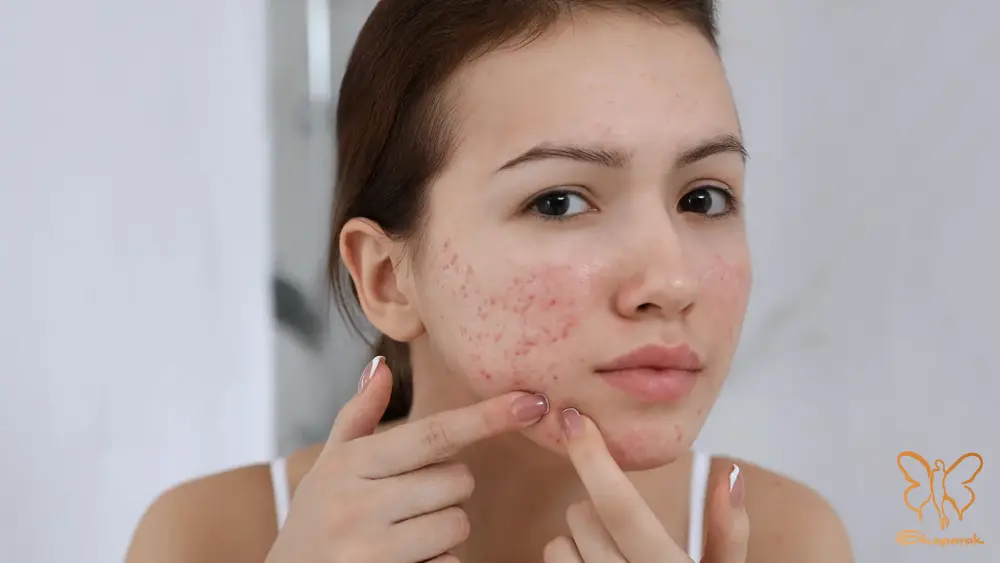 پوست های مستعد آکنه شدید پوست های مستعد آکنه شدید