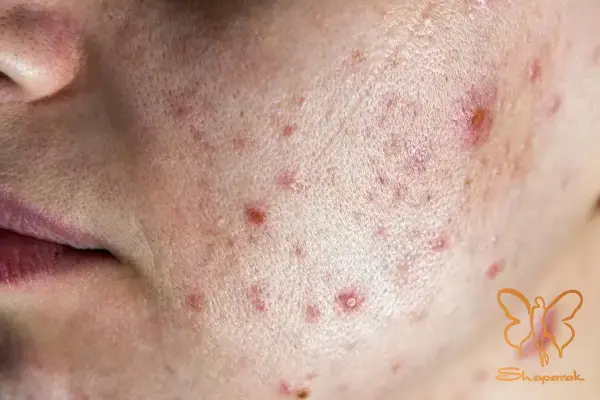 تفاوت کلیدی جوش ندول و جوش کیستیک چیست تفاوت کلیدی جوش ندول و جوش کیستیک چیست