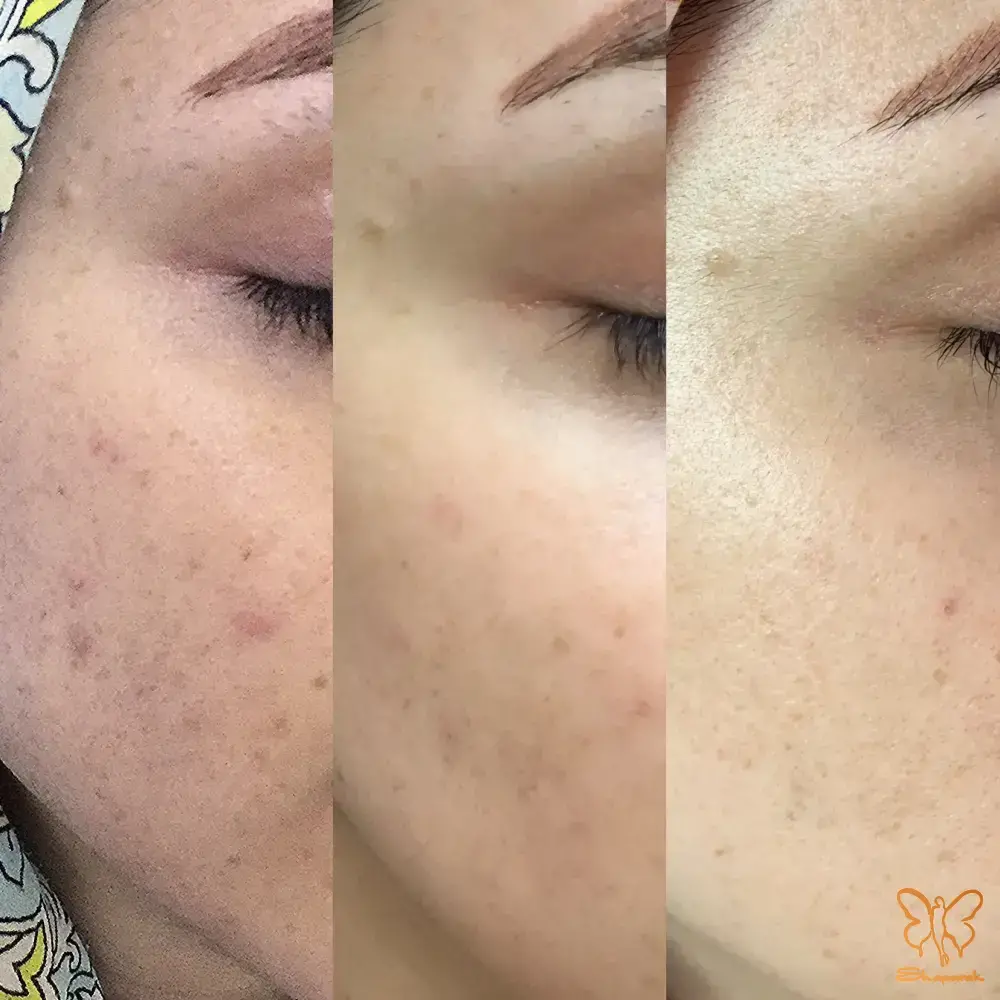 فیشیال تخصصی پوست مشهد
