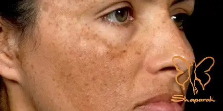 دلایل ایجاد لکه های ملاسما در کلینیک شاپرک طلایی مشهد