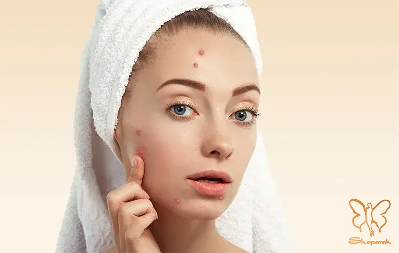 اگزما Eczema اگزما Eczema