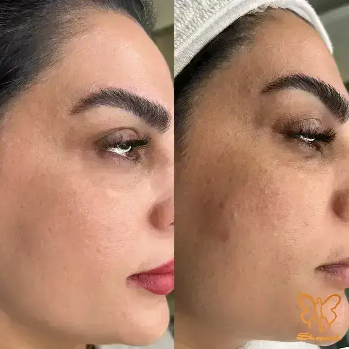 فوتونا مزو فرکشنال مشهد