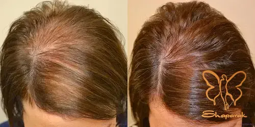 رشد مو و تقویت ساقه مو با تزریق هیرفیلر در شاپرک طلایی رشد مو و تقویت ساقه مو با تزریق هیرفیلر در شاپرک طلایی