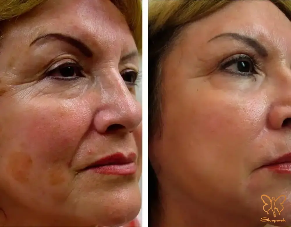 کلینیک تخصصی لیزر موهای زائد شاپرک طلایی مشهد کلینیک تخصصی لیزر موهای زائد شاپرک طلایی مشهد