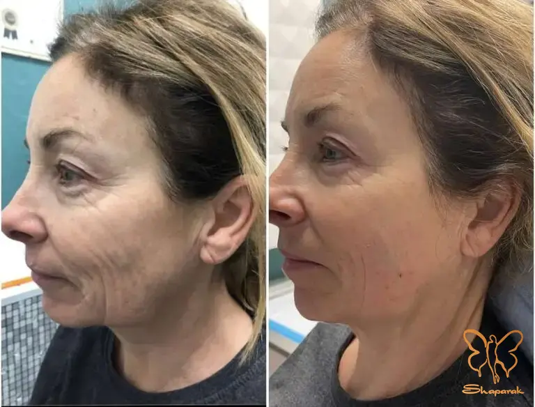 فوتونا فرکشنال مشهد فوتونا فرکشنال مشهد