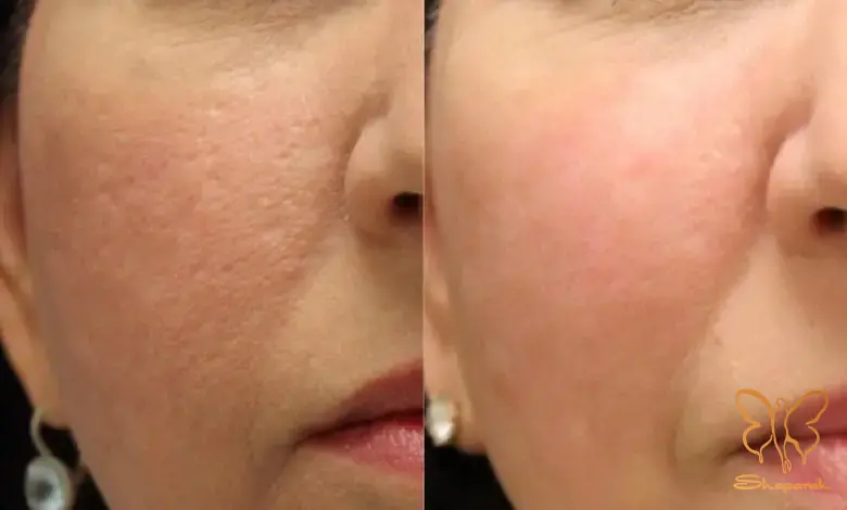 آراف فرکشنال صورت مشهد RF آراف فرکشنال صورت مشهد RF