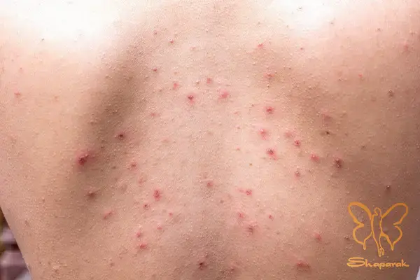 نقش هورمونها و ژنتیک در ایجاد آکنه ندولار نقش هورمونها و ژنتیک در ایجاد آکنه ندولار