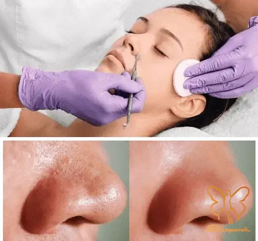 پاکسازی های تخصصی مشهد معجزه داشتن پوستی با کیفیت
