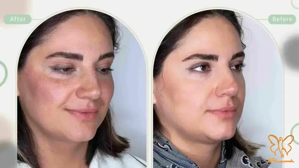  پاکسازی تخصصی پوست مشهد