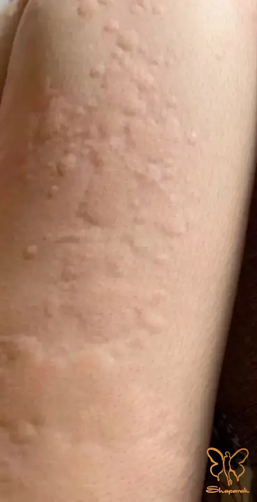 نقش چرخه رشد مو در اثربخشی لیزر نقش چرخه رشد مو در اثربخشی لیزر