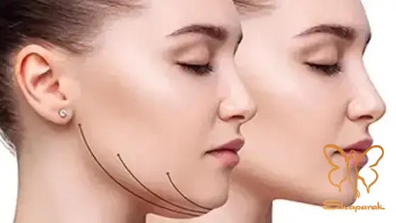 ۵ فعالیت شدید و عدم رعایت مراقبتهای بعد از عمل