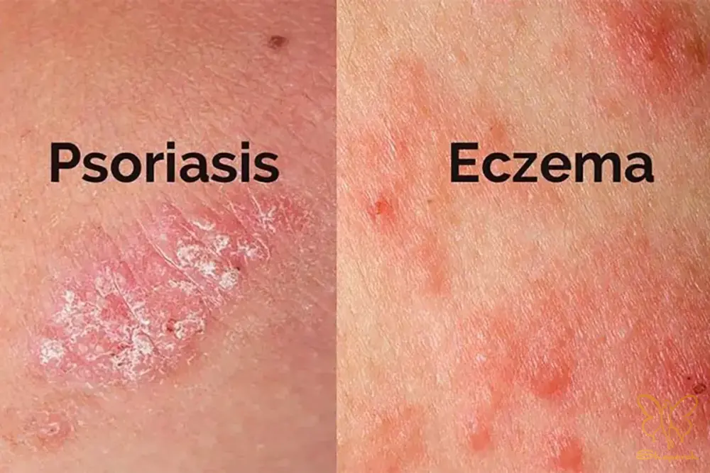  Psoriasisپسوریازیس