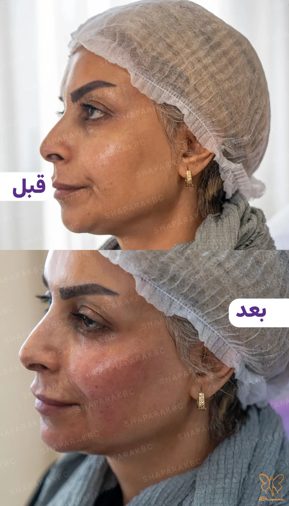 تعهد به نتایج نچرال و ایمن در تزریق فیلر صورت تعهد به نتایج نچرال و ایمن در تزریق فیلر صورت