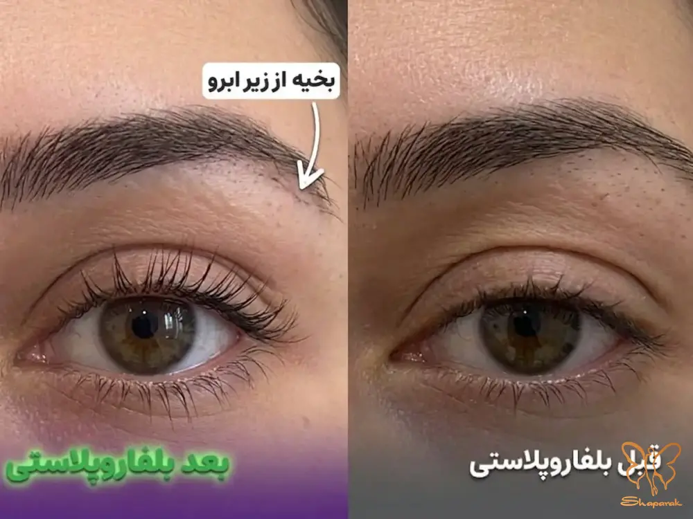 اهمیت انتخاب روش صحیح جراحی چشم