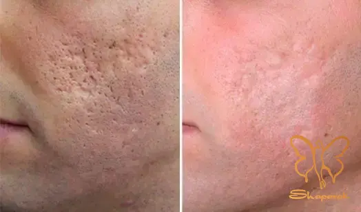 کربوکسی تراپی در مشهد کربوکسی تراپی در مشهد