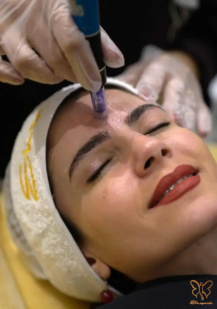 میکرونیدلینگ در کلینیک شاپرک طلایی