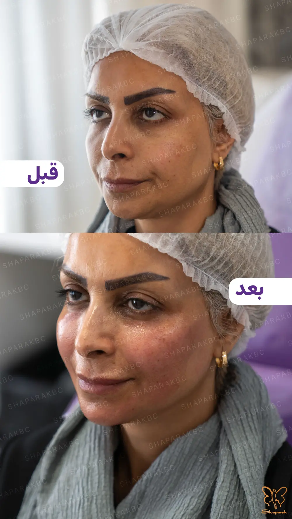 تکنیک اختصاصی فیس لیفت مایع در مشهد