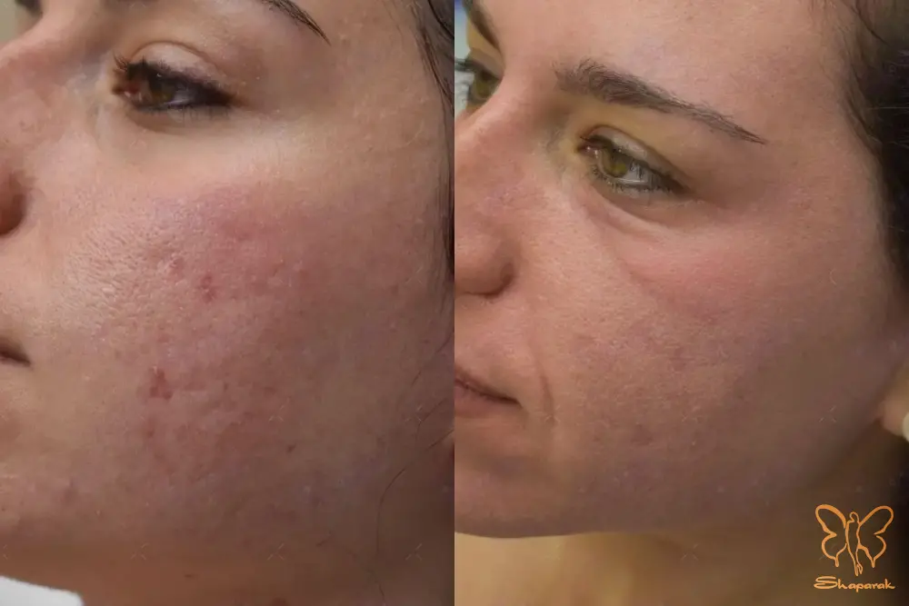 کلینیک تخصصی لیزر موهای زائد شاپرک طلایی مشهد کلینیک تخصصی لیزر موهای زائد شاپرک طلایی مشهد