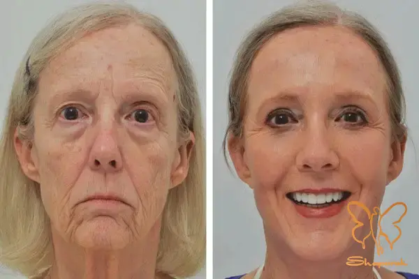 مزوتراپی صورت و سر مشهد مزوتراپی صورت و سر مشهد