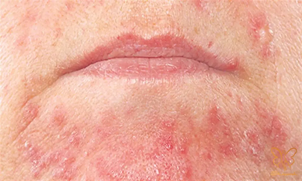 درماتیت استاز Stasis Dermatitis درماتیت استاز Stasis Dermatitis