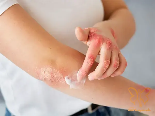 درماتیت آتوپیک Atopic Dermatitis درماتیت آتوپیک Atopic Dermatitis